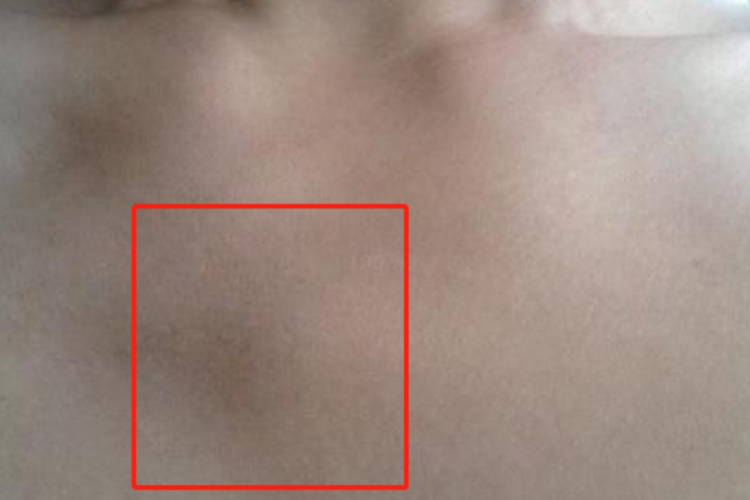 胸骨柄正常凸起图