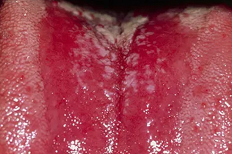 艾滋病期舌头红肿图