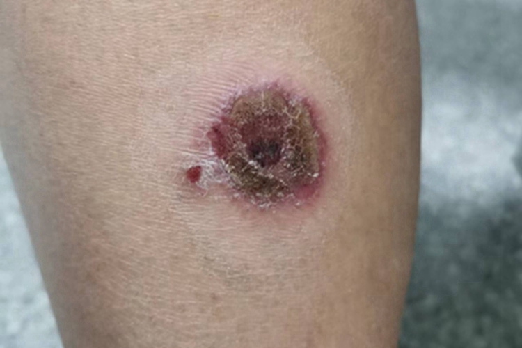 钱币状湿疹小腿结痂图