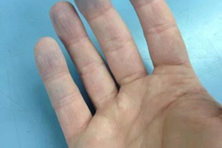 冷球蛋白血症皮肤发青图