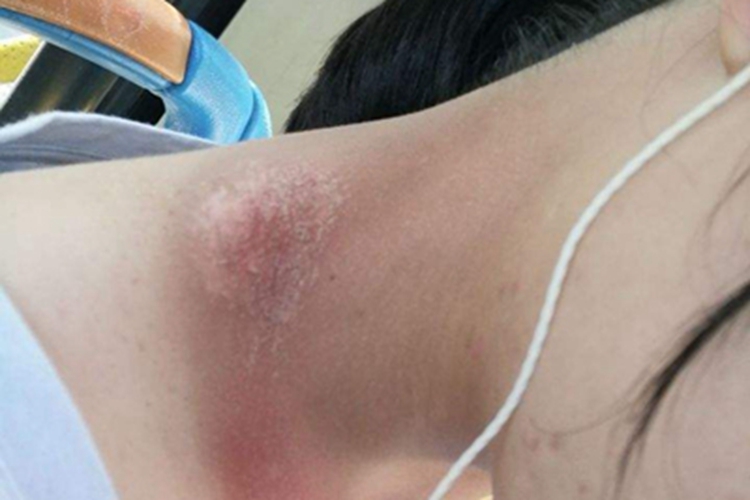 日光性皮炎侧颈脱屑图 日光性皮炎侧颈脱屑图