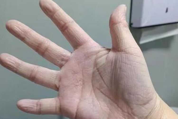 脱水手指头干瘪有竖纹图