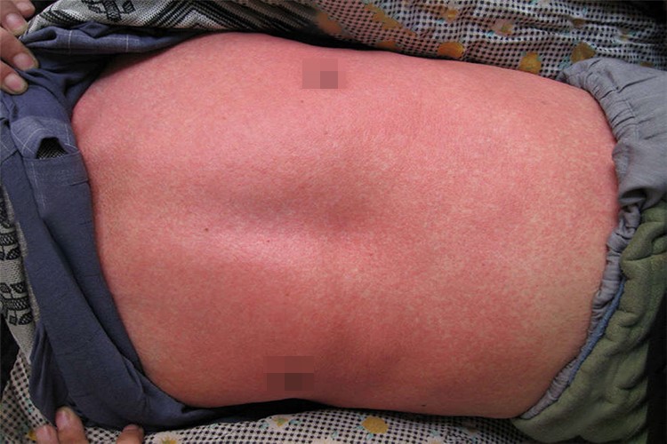 猩红热型皮疹图