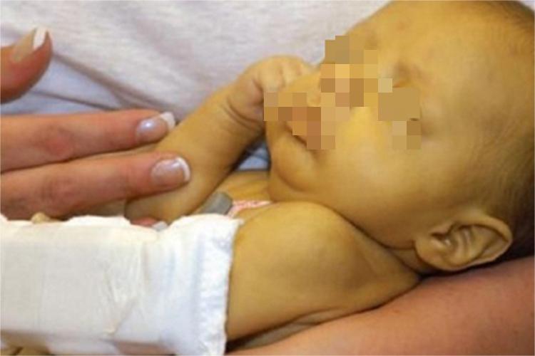 先天性非溶血性黄疸皮肤发黄图 先天性非溶血性黄疸皮肤发黄图