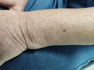脂溢性角化病胳膊上褐色斑点图