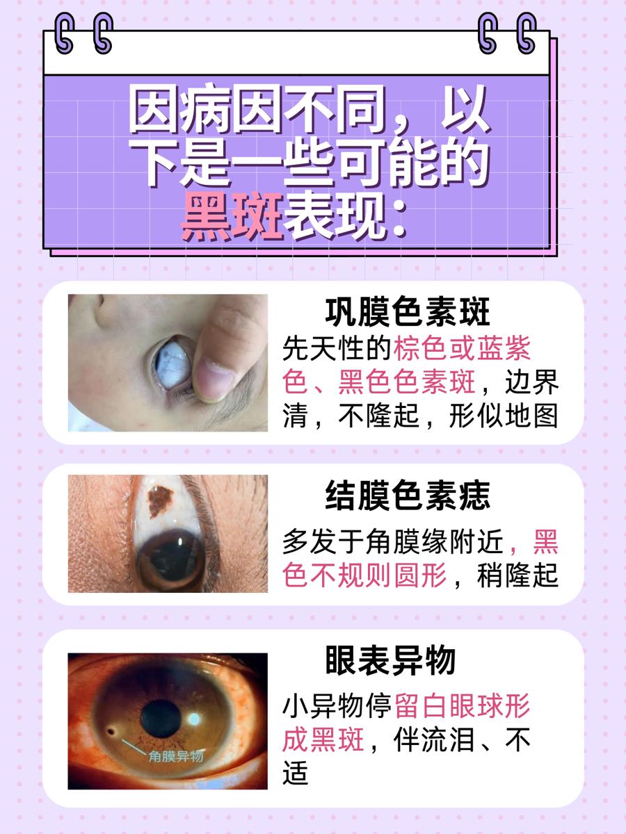 白眼球上有黑斑图片