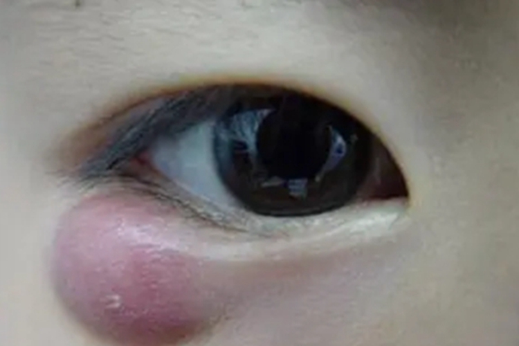 霰粒肿眼睑大疙瘩图 霰粒肿眼睑大疙瘩图