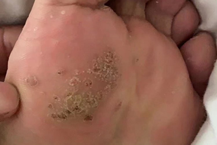 寻常疣脚底好多疹子图