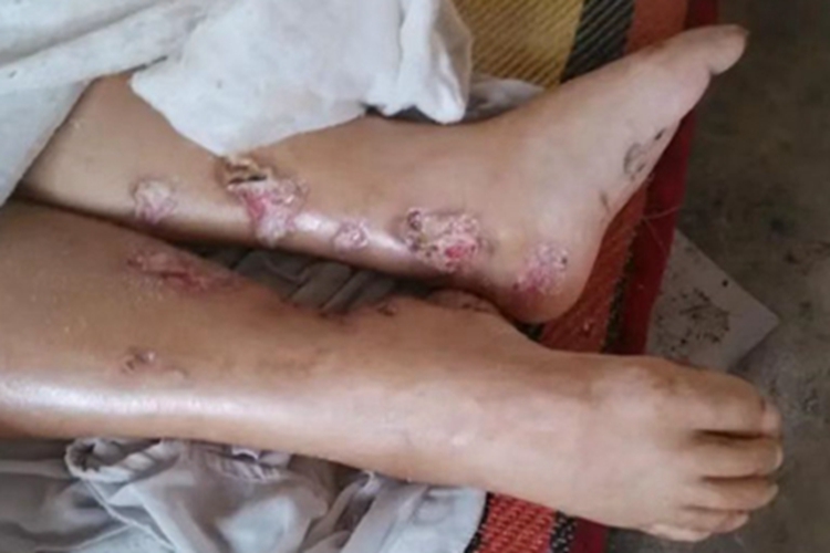 小螺菌型鼠咬热溃疡图