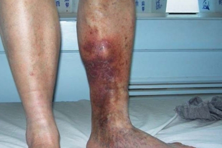 血栓性浅静脉炎红斑图