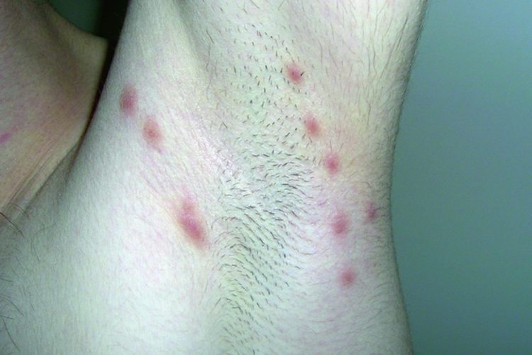 疥疮结节图