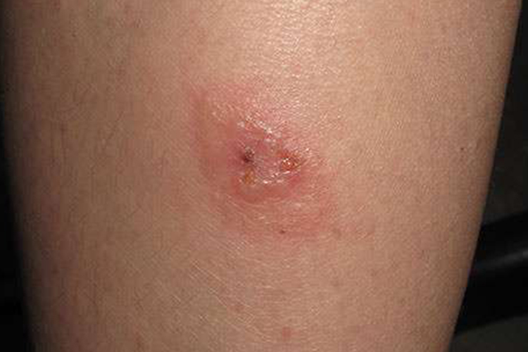 水疱破溃后皮损图