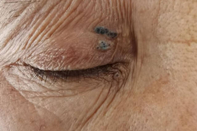 黑头粉刺痣眼部症状图 黑头粉刺痣眼部症状图