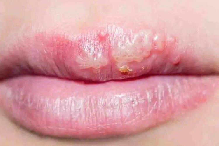 口唇疱疹症状图 口唇疱疹症状图