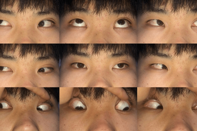 先天性上斜肌麻痹图