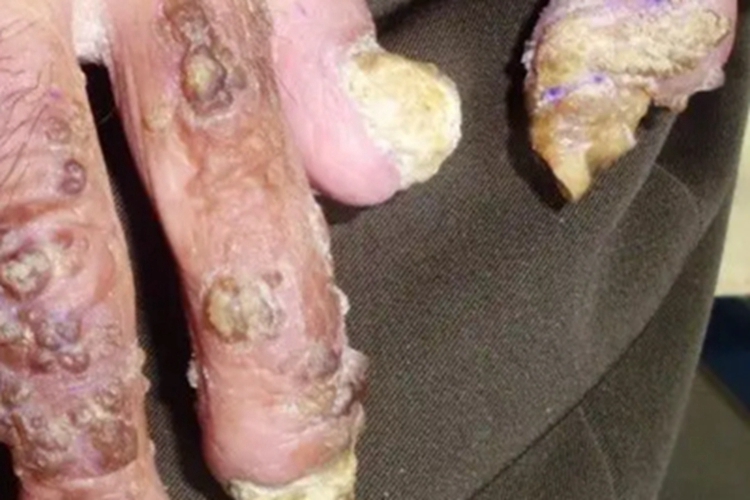 慢性黏膜皮肤念珠菌病手指结节图