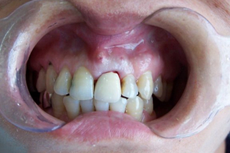 牙槽脓肿牙龈脓肿图