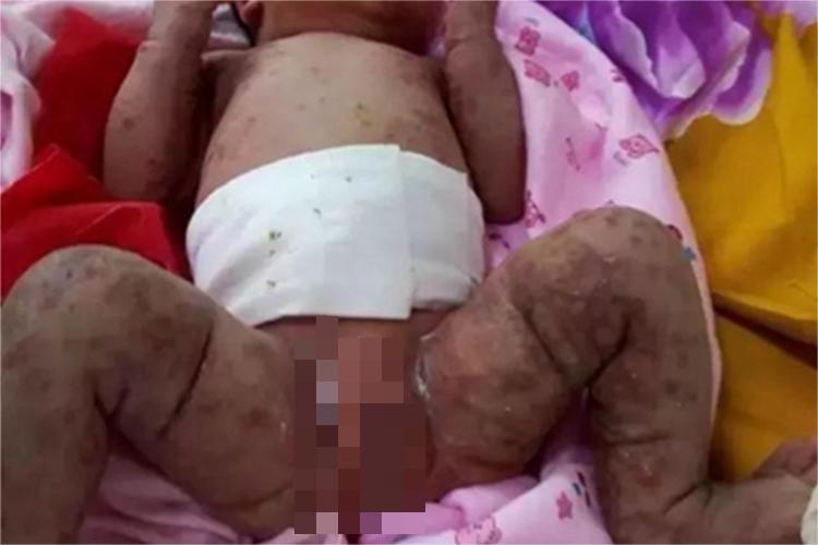 色素失调症全身症状图 色素失调症全身症状图