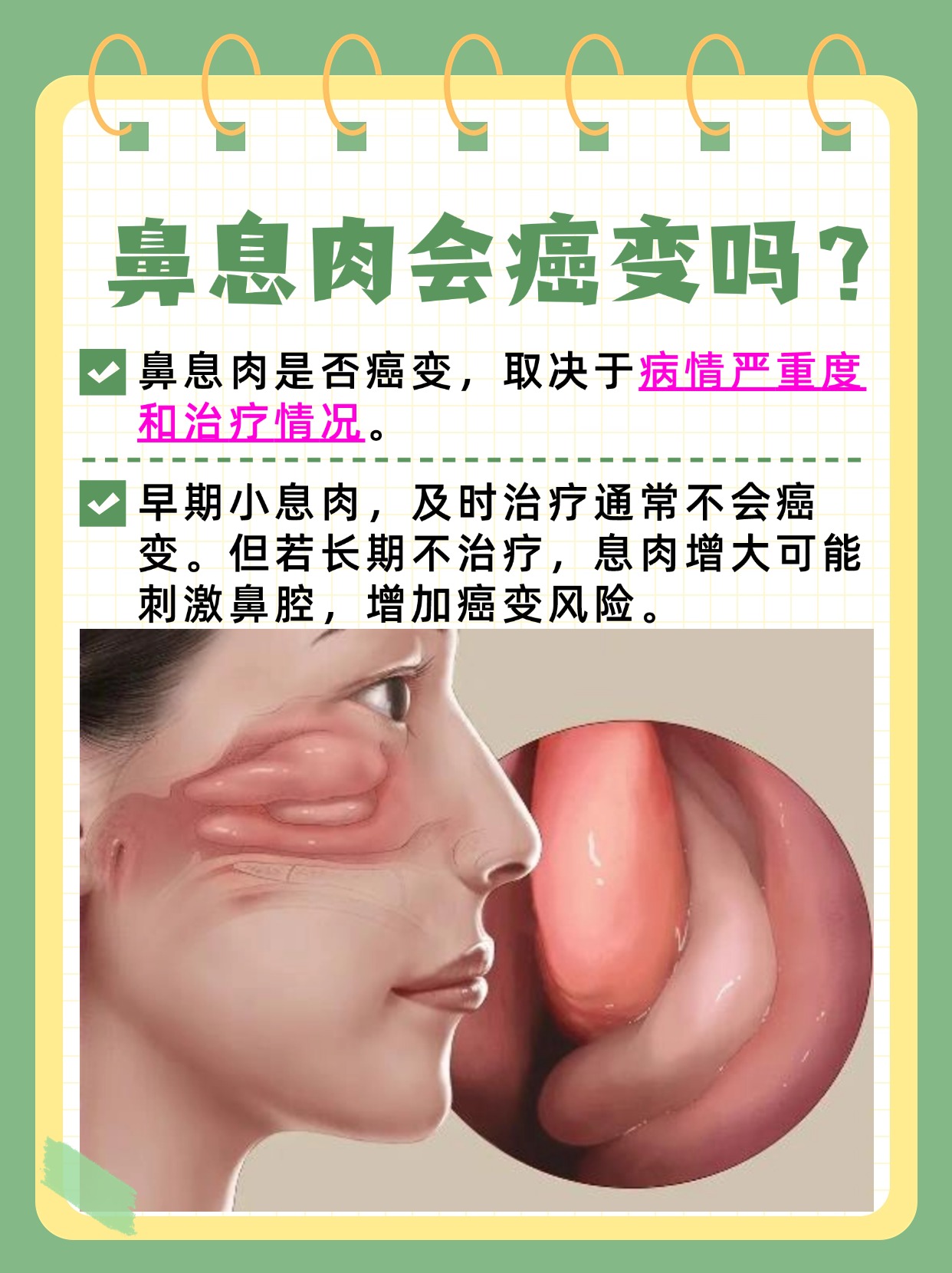 鼻息肉会癌变吗？听专家怎么说