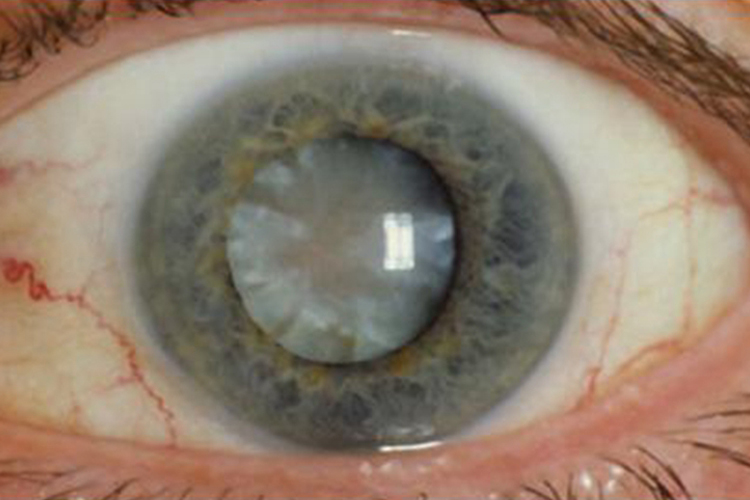 并发性白内障图