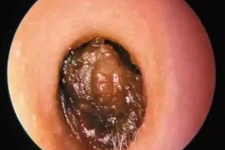 耵聍栓塞外耳道硬块图