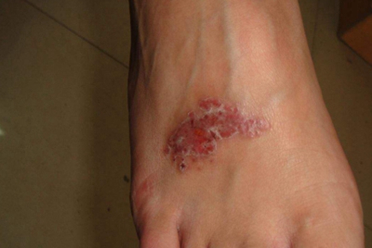 弥漫性躯体性血管角化瘤症状图