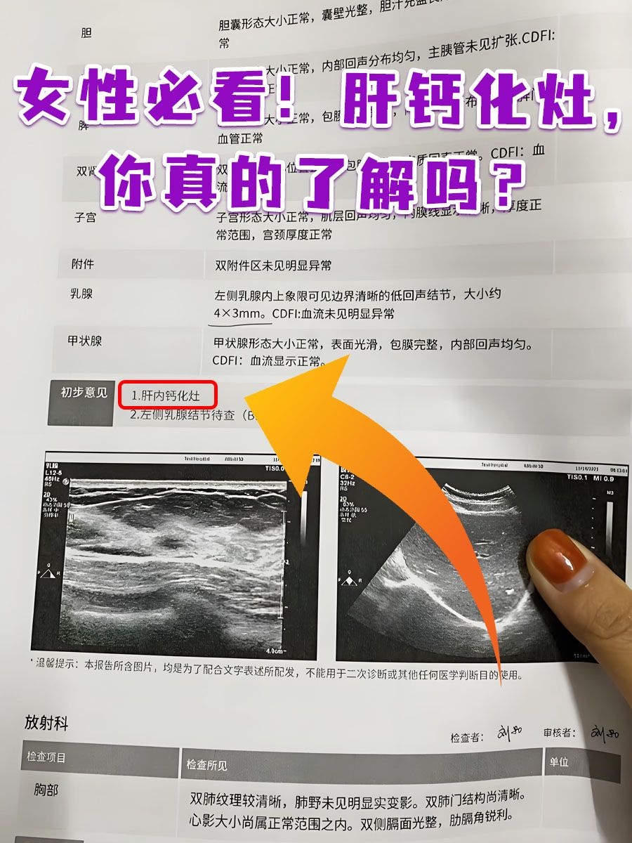 女性必看！肝钙化灶，你真的了解吗？