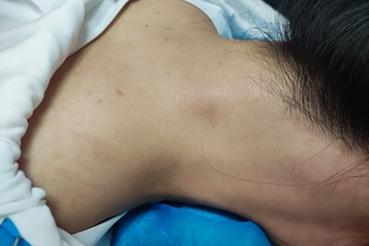 神经性皮炎斑图 神经性皮炎斑图