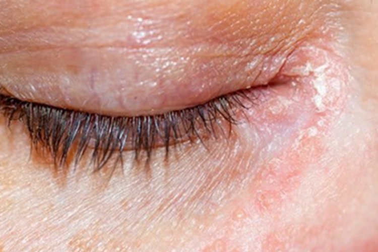 亚急性眼睑湿疹眼睑症状图 亚急性眼睑湿疹眼睑症状图
