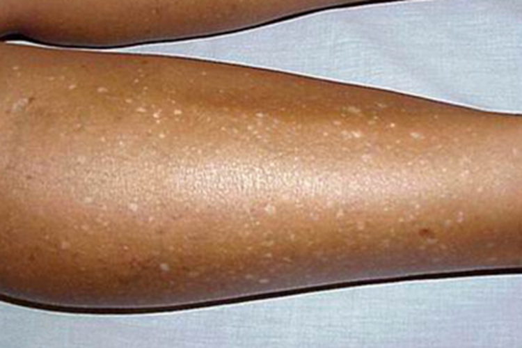 特发性滴状色素减少症小腿症状图 特发性滴状色素减少症小腿症状图