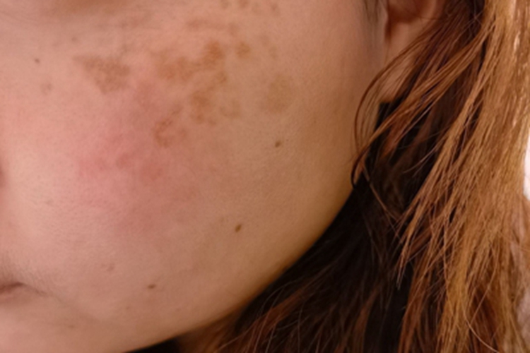 颧部褐青色痣脸上有灰褐色斑块图