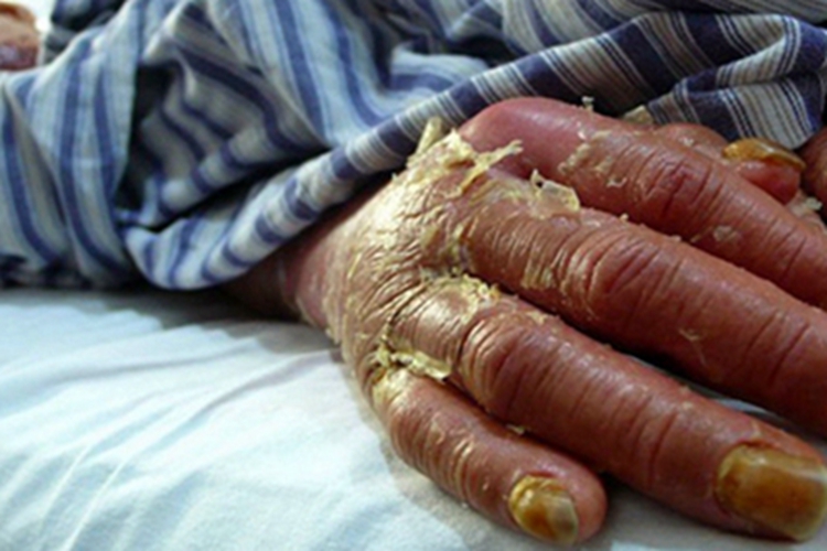 剥脱性皮炎型药疹手背症状图