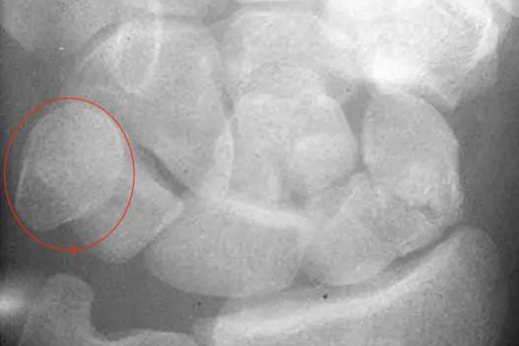 手腕豆状骨影像图