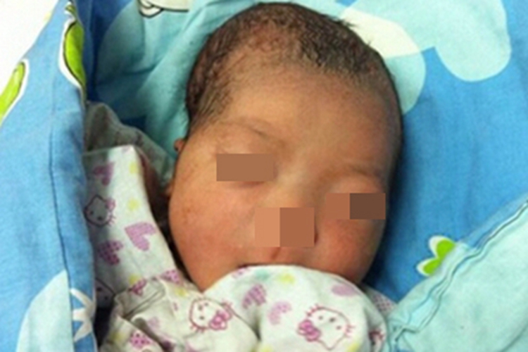 产瘤头部变形图 产瘤头部变形图