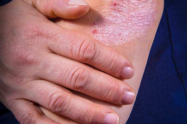 关节病型银屑病肘部脱屑图 关节病型银屑病肘部脱屑图