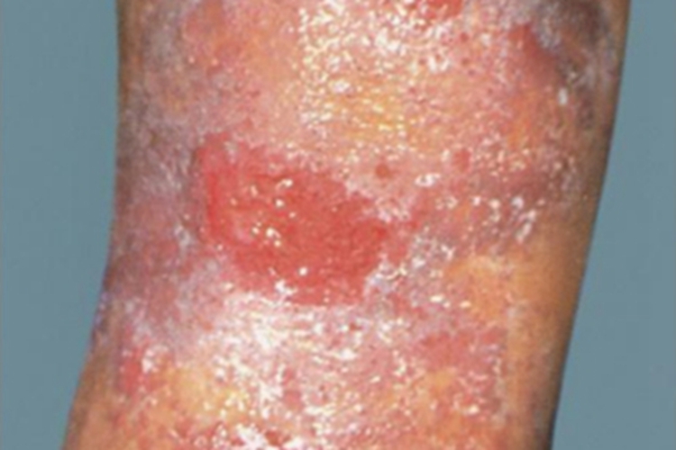 湿疹型药疹脱屑图