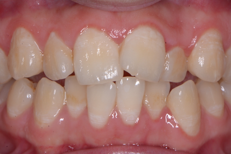 轻度牙列拥挤图 轻度牙列拥挤图