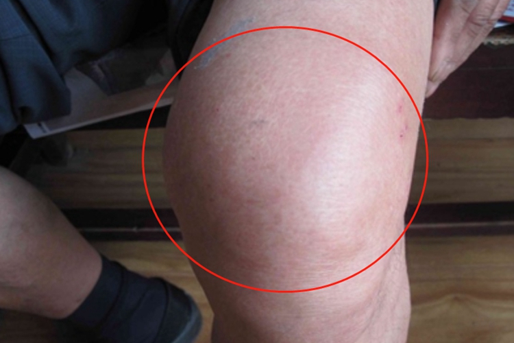 风湿性关节炎膝盖红肿图