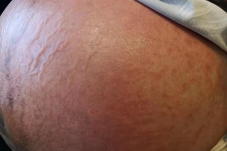 妊娠多形疹腹部症状图 妊娠多形疹腹部症状图