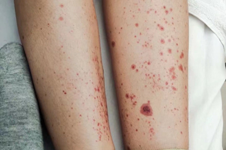 过敏性紫癜小腿血痂图 过敏性紫癜小腿血痂图