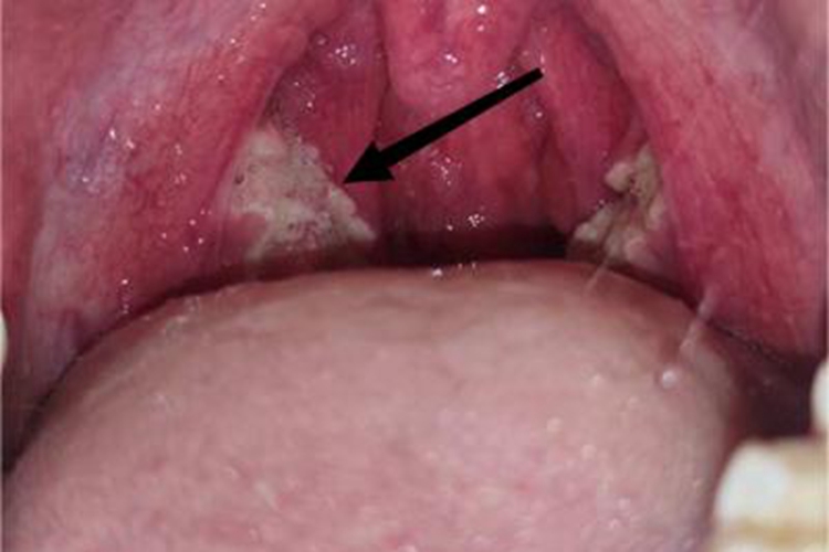 慢性扁桃体炎咽喉症状图