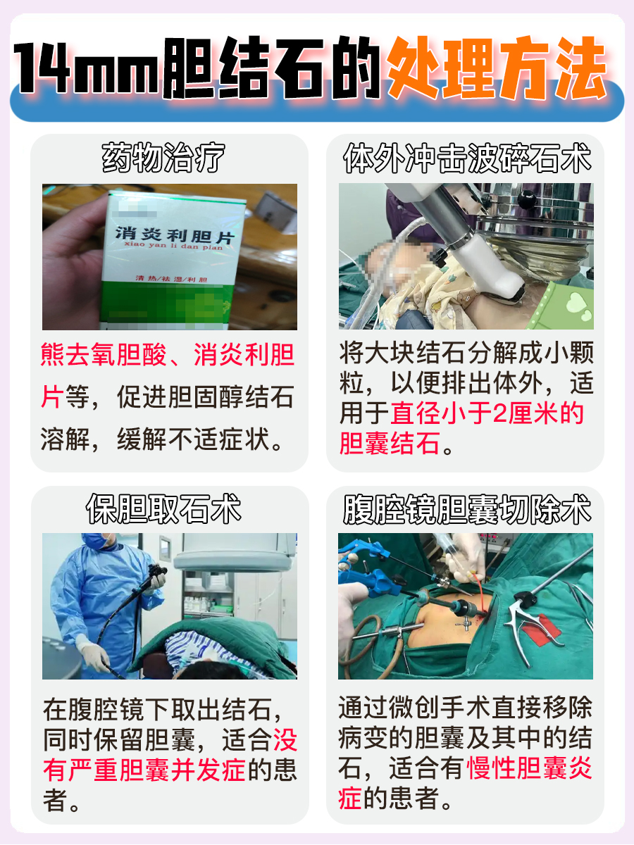 胆结石14mm：是大？还是小？