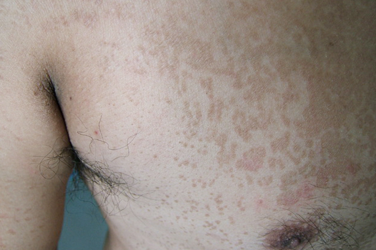 胸口花斑癣图