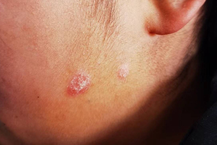 银屑病面部症状图