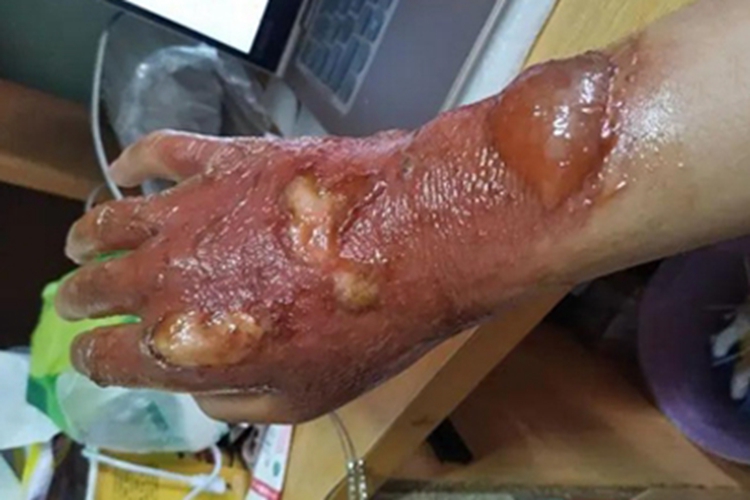 二度烫伤手背水疱图 二度烫伤手背水疱图