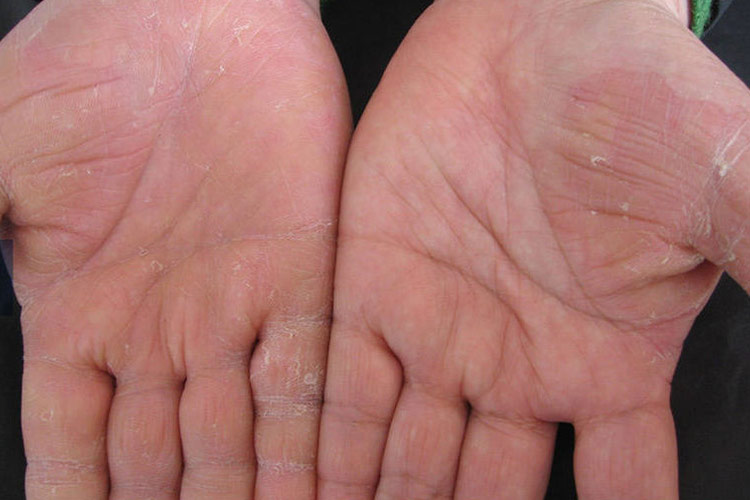 手癣鳞屑角化型图