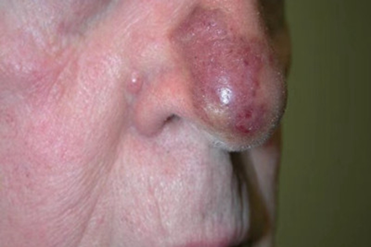 特发性头颈部血管肉瘤紫斑图 特发性头颈部血管肉瘤紫斑图