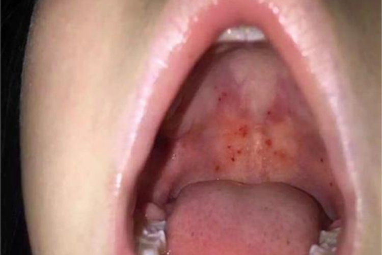 小儿疱疹性咽峡炎咽峡红点图
