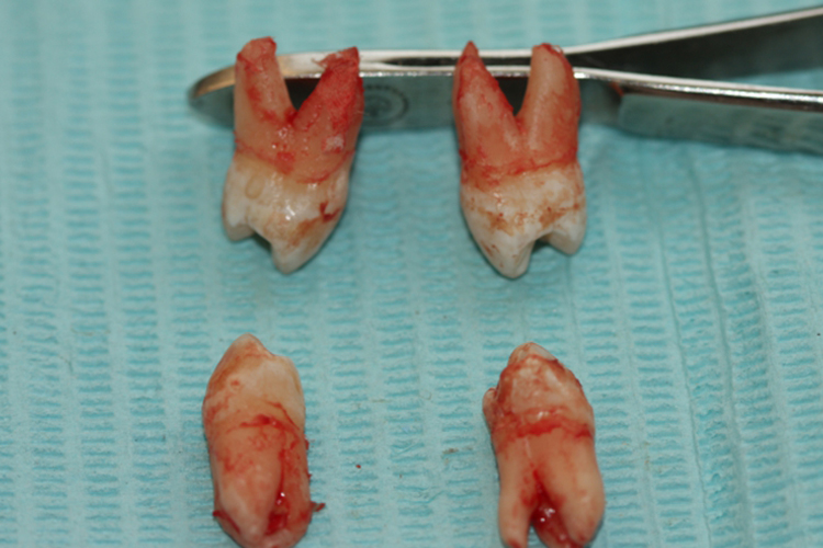 磨牙牙根形态图