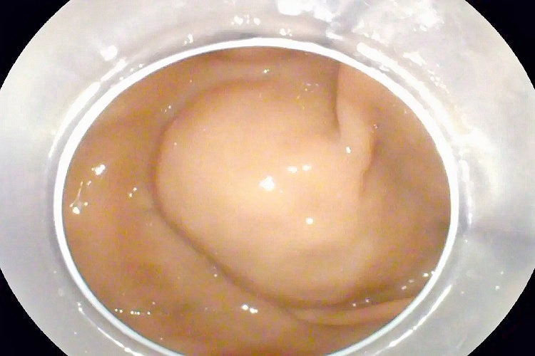 胃囊肿有蒂胃镜影像图